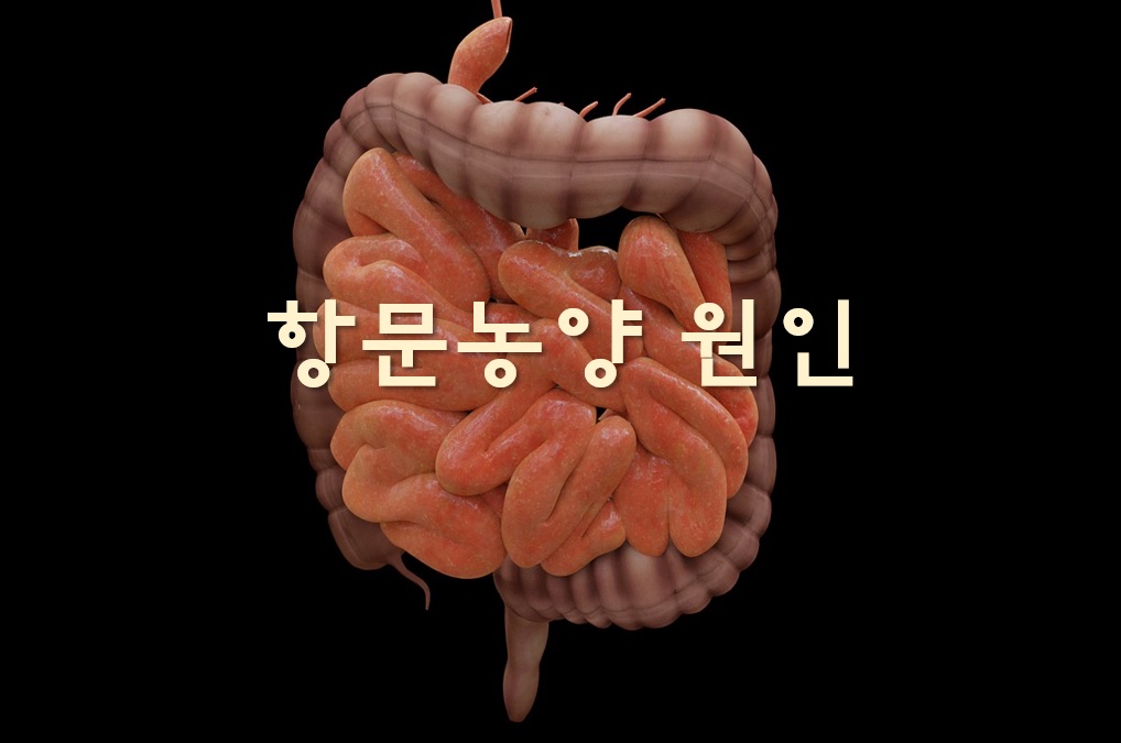 항문농양 원인과 수술 후 치루 발생 가능성