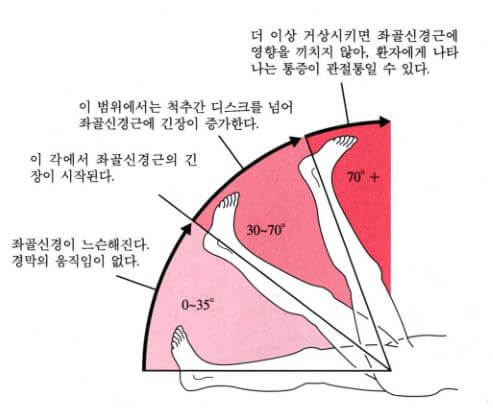 각도별 통증과 그에 따른 증상을 설명하는 그림