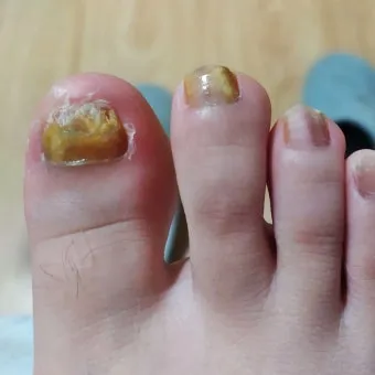 라셀턴 사용법과 가격 비교 발톱앰플 후기 정리해보기_3