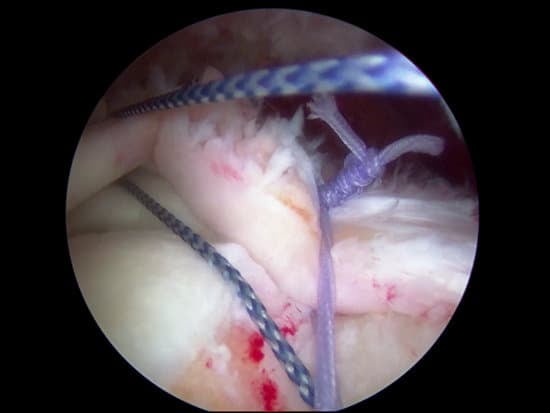 회전근개 파열 (Rotator Cuff Tear)로 인한 관절경 수술