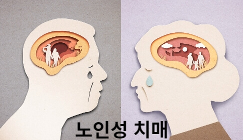 노인성치매