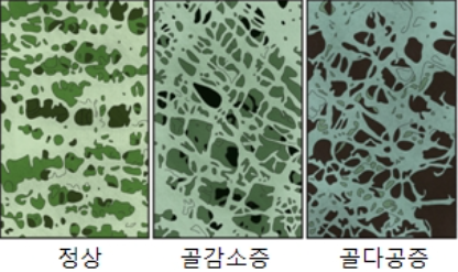  골감소증 원인/증상/치료법