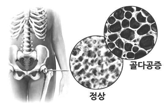 골다공증-뼈-사진