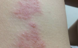 대상포진 초기증상