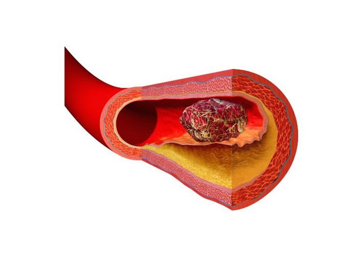 혈전이 혈관을 막은 모습