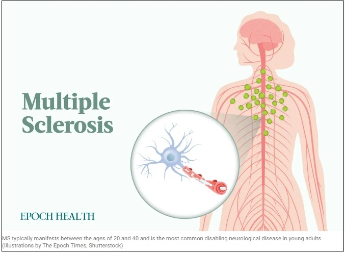 다발성&nbsp;경화증(MS): 증상&#44;&nbsp;원인 및&nbsp;치료&nbsp; The Essential Guide to Multiple Sclerosis: Symptoms&#44; Causes&#44; Treatments&#44; and Natural Approaches