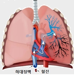  폐색전증의 원인과 증상