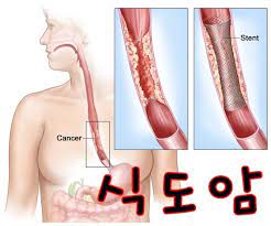  식도암이란?