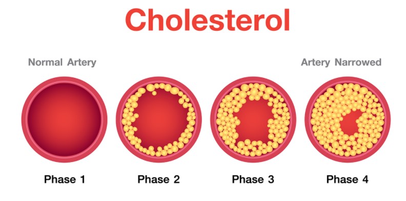 콜레스테롤 단계