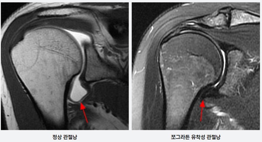  오십견 증상 수술하지 않고 치료하는 어깨정형외과 치료병원