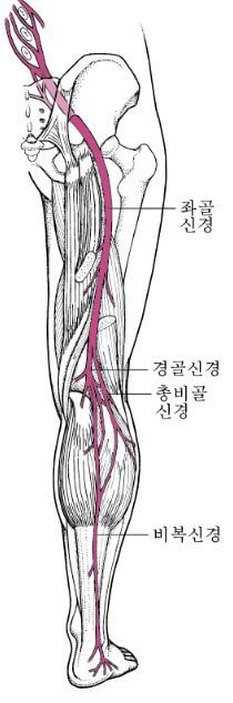 좌골신경통