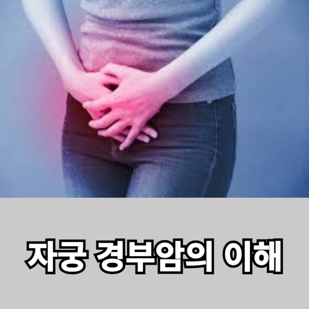  자궁 경부암의 이해 증상 진단 및 치료법