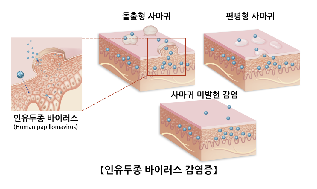 인유두종바이러스