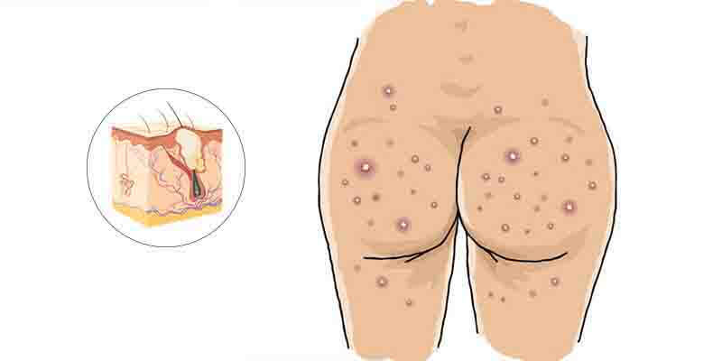 pimples on the buttocks