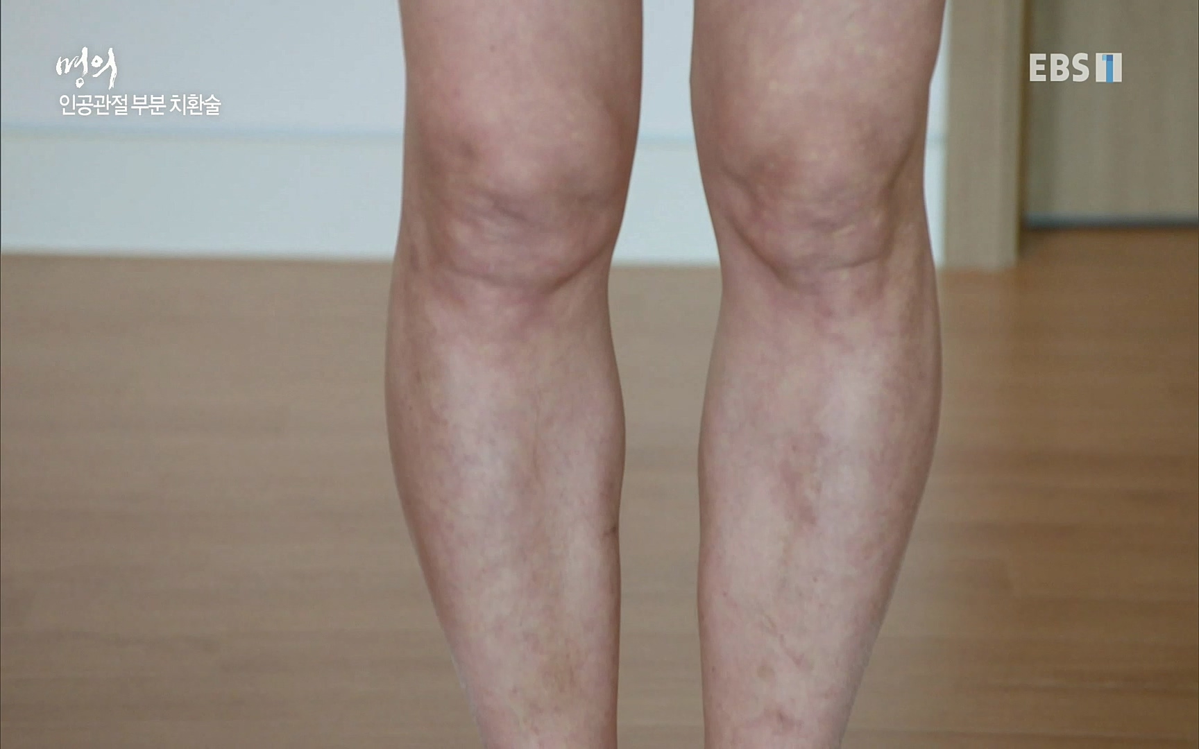 EBS 명의 헬스케어 - TV - 교육의 중심 EBS무릎 건강 프로젝트 2부 새 무릎으로 사는 법 .mp4_20220726_202336.920.jpg