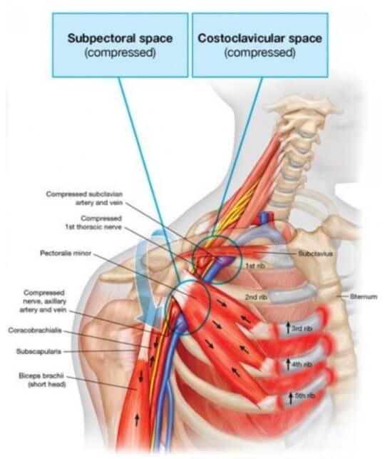 쇄골아래쪽 공간과 오두돌기 아래 공간을 나타내는 그림으로 쇄골하근과 소흉근에 의해서 압박되는 포인트를 그림으로 나타냈음.