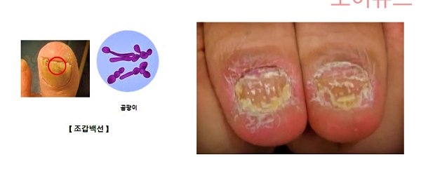 조갑진균증(손발톱무좀)