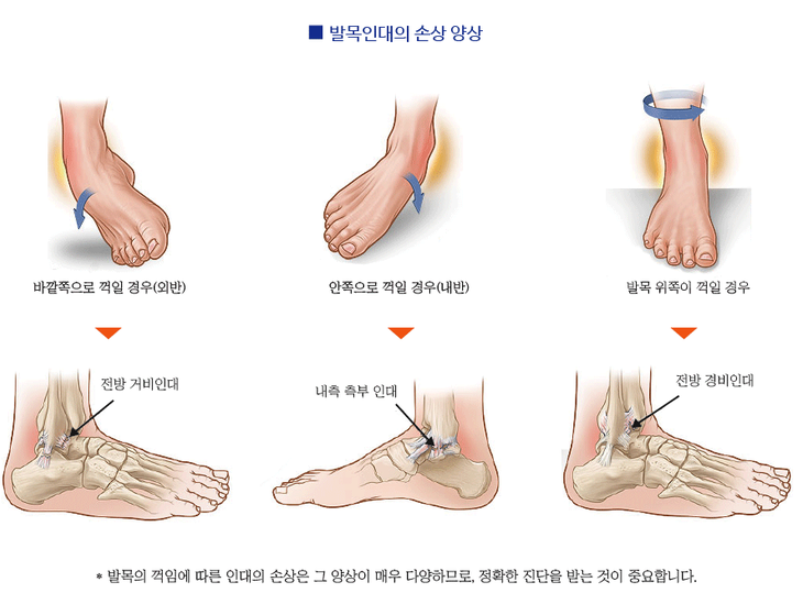 발목 인대 치료 방법은 어떻게 이뤄질까. 5