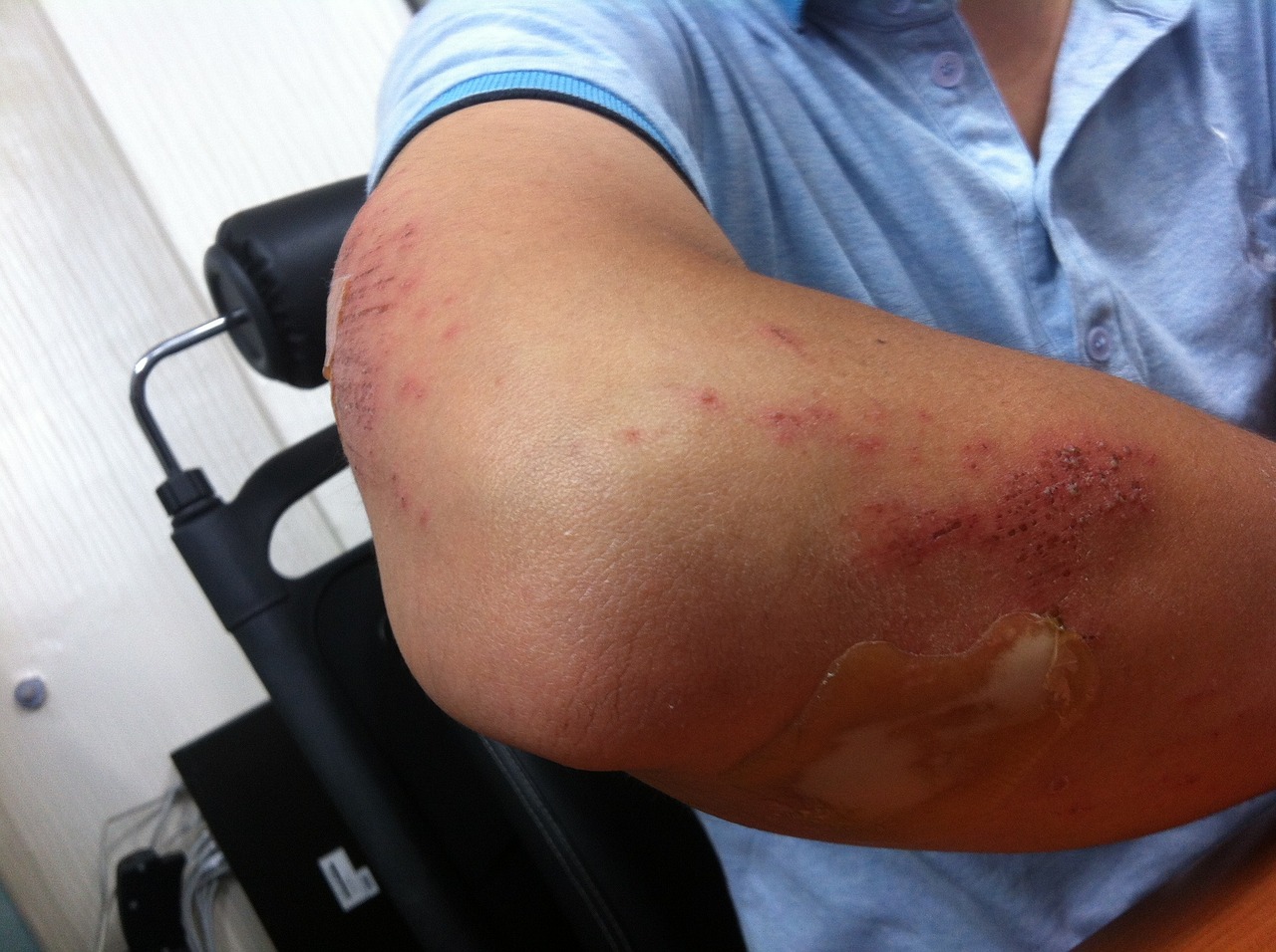 팔꿈치 부상 ( Tennis Elbow )