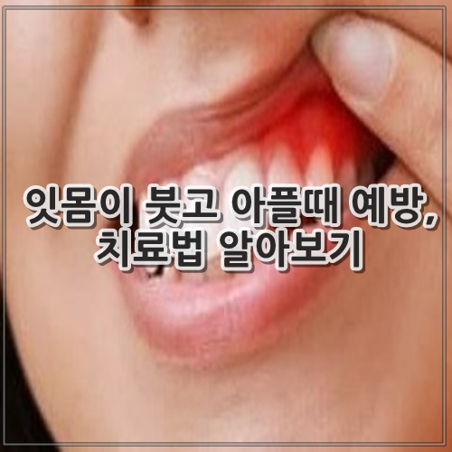 잇몸이 붓고 아플때 예방, 치료법 알아보기