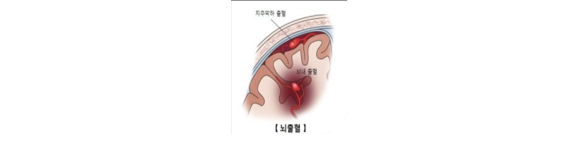 뇌출혈 초기증상 모르면 큰일납니다.