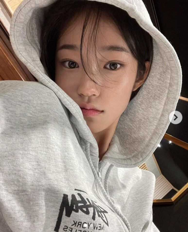  노윤서 입꼬리 필러 보톡스 성형설