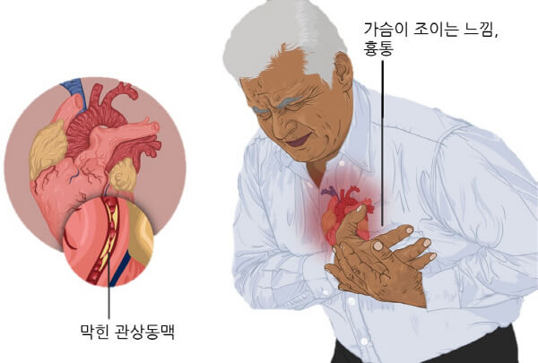 의학용어 MI : STEMI, NSTEMI 알아보기 6