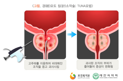 전립선 수술