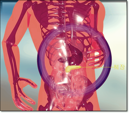 괴사성 급성 췌장염