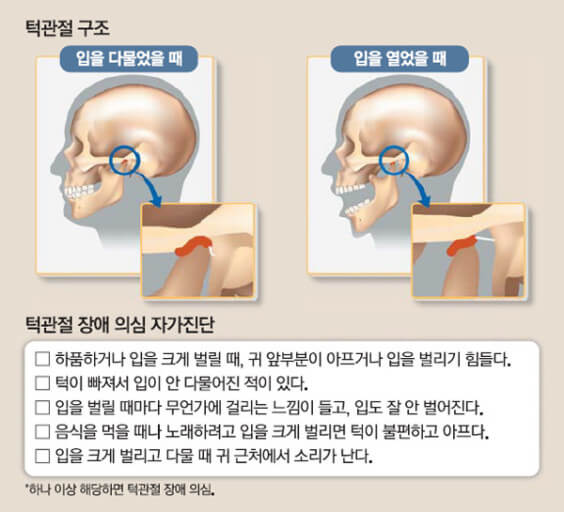 턱관절 장애 구조