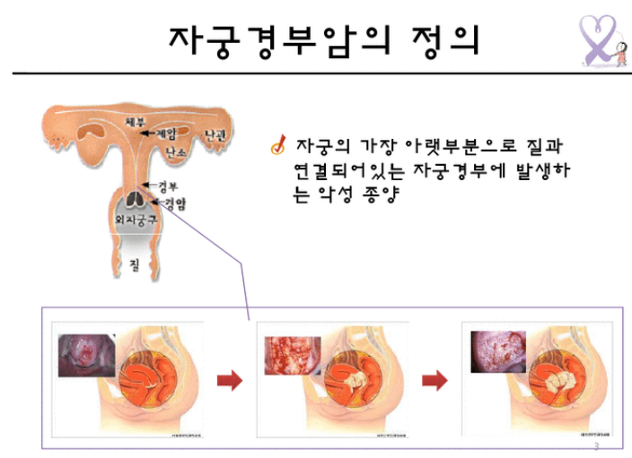 자궁경부암 예방접종 가격 자궁경부암 무료접종 대상