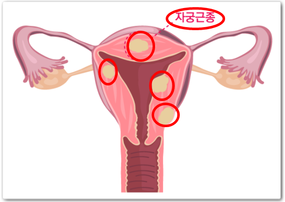  자궁근종 증상과 치료법