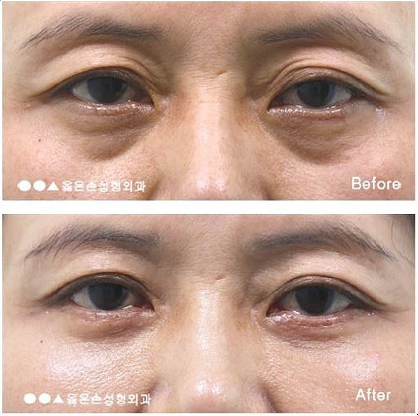상안검 수술 후기 반드시 참고해야 한다 9