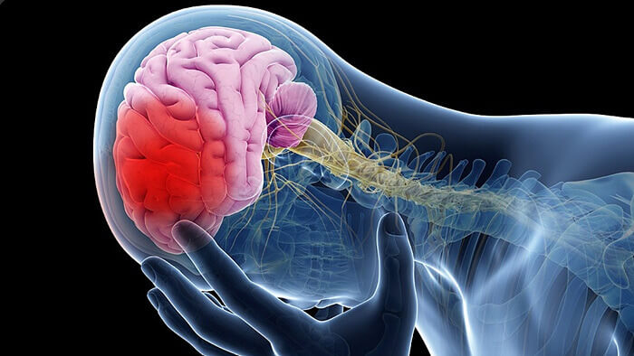  뇌졸중(腦卒中,stroke) 바로 알기