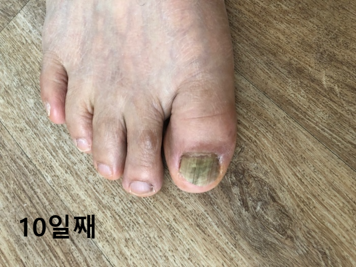 발톱변색약