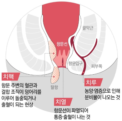 치질 증상