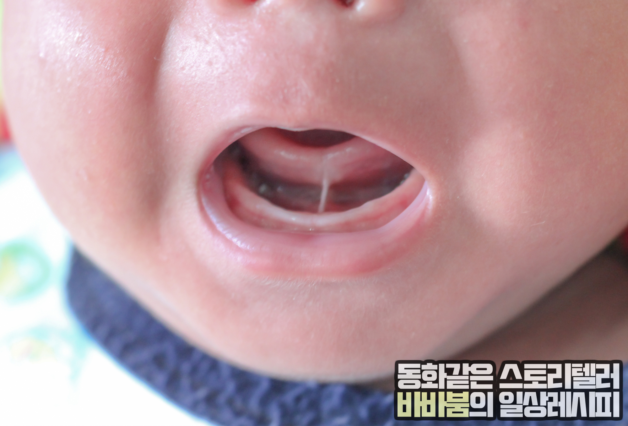  설소대가 짧은 아기, 어떻게 해야 할까요?