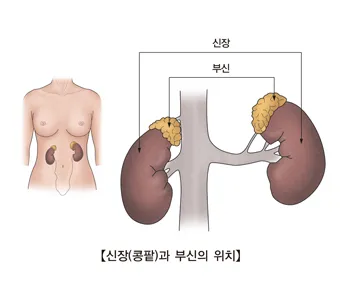 부신암 증상 치료법 예방 관리방법_1