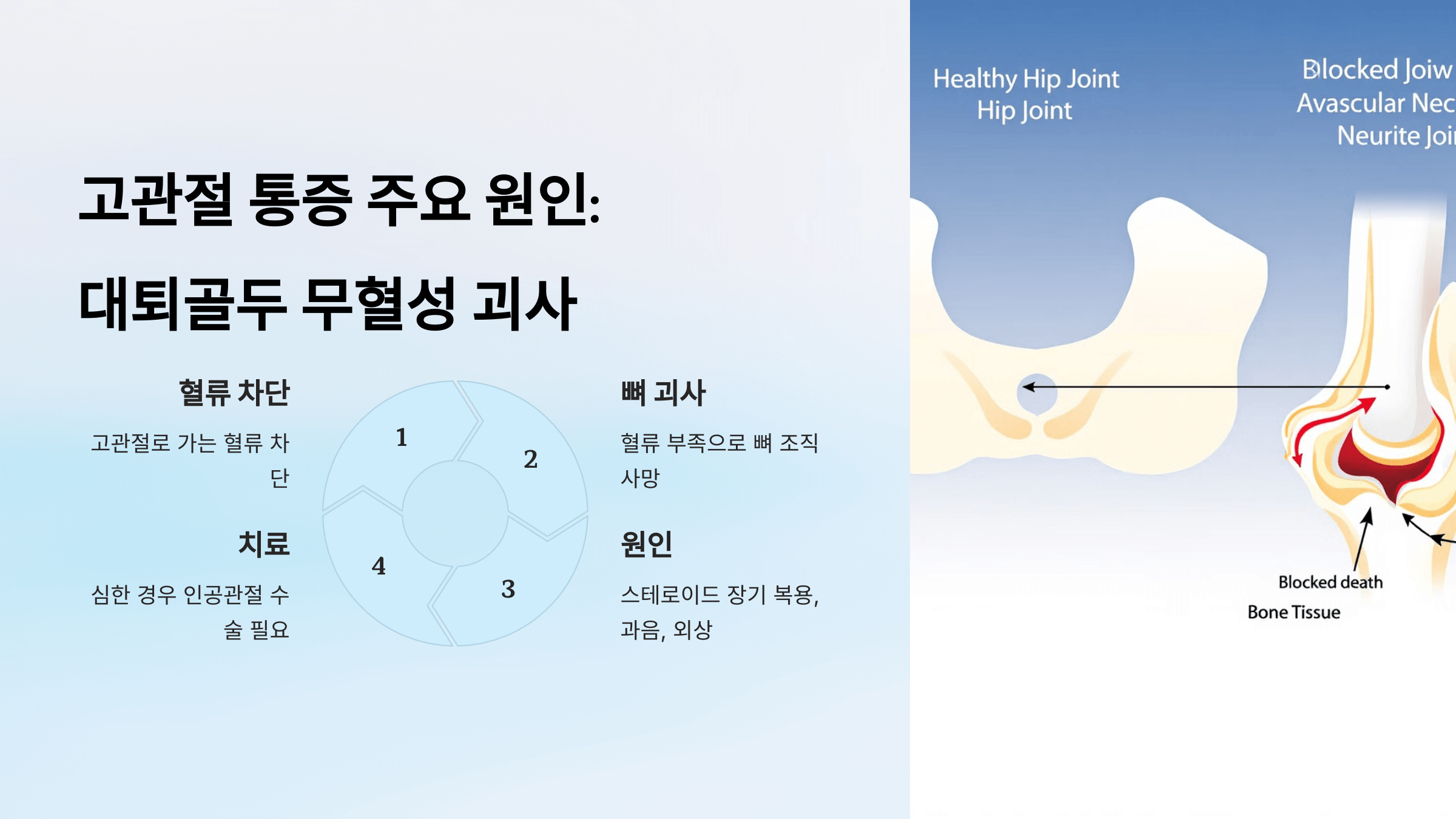 고관절 사진입니다.