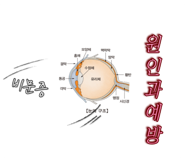 비문증 원인과 예방