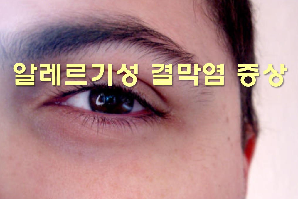  알레르기성 결막염 증상과 전염 가능성