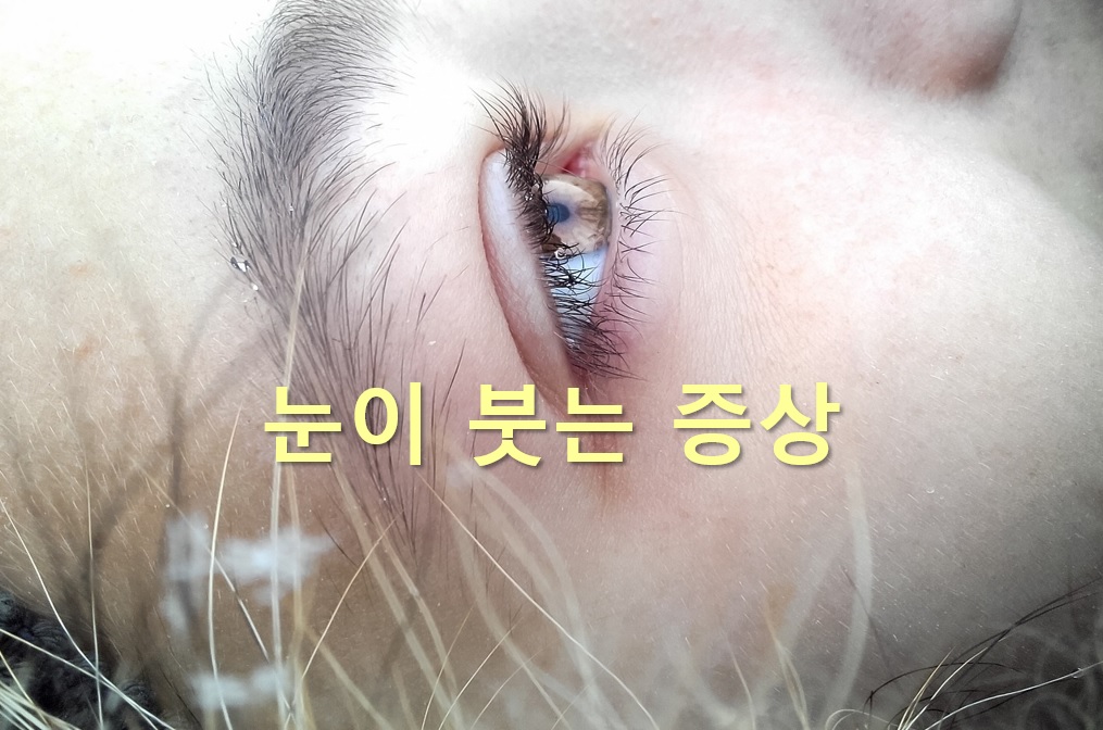  눈이 붓는 증상과 눈이 아픈 이유