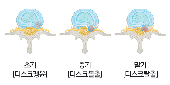 허리디스크 증상 허리디스크에 좋은 운동 다리저림 자가진단 치료법