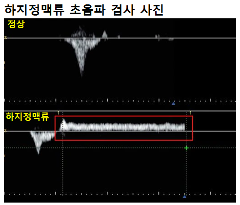 하지정맥류 초음파 검사 사진이다. 검사기를 이용해서 종아리를 눌렀을때 위 사진처럼 아래로 V가 한번 나타나면 정상. 아래 사진처럼 V가 나타나고 윗쪽으로 신호가 1초 이상 유지되면 하지정맥류로 진단된다.