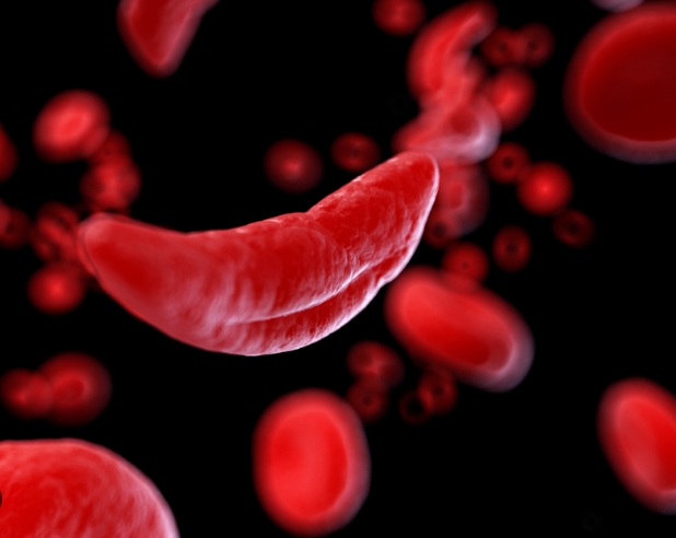 1회 투약 비용이 41억원?: 세계 최고 비싼 약 순위 FDA Approves First Gene Therapies to Treat Patients with Sickle Cell Disease