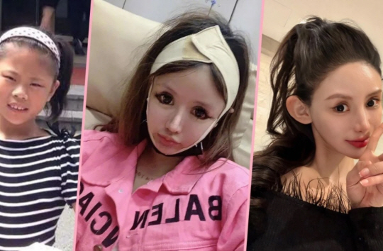  여배우를 동경해 13세 때부터 100회 넘게 성형수술을 한 여성이 성형 중단을 선언