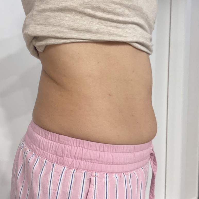 한달째 배살빼는법 실행결과 복부지방분해주사 - 5