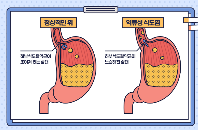 역류성 식도염 치료제 부작용