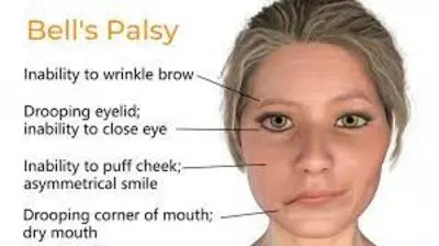 Bell&#39;s palsy