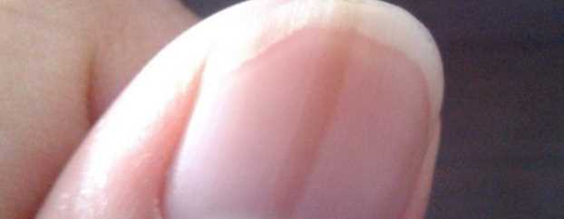 손톱 세로줄이 생기는 이유 - 단순 상처에 의한 색소 침착
